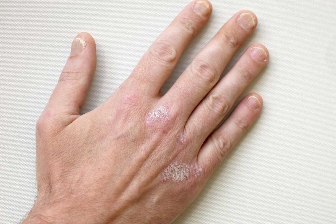 Psoriasis in the hands of a man is treated with Keramin cream