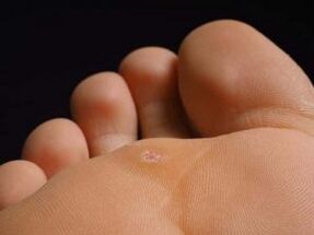 Causes of plantar war