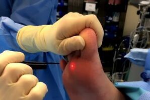 Surgical methods of removing warts