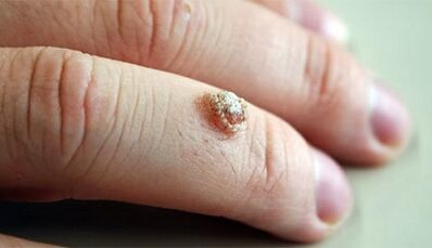 Methods of treatment of warts with Celandine