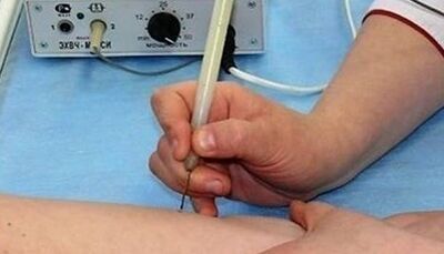 How to get rid of papiles in the body
