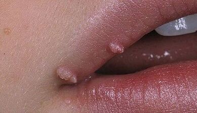 Papilloma types in people