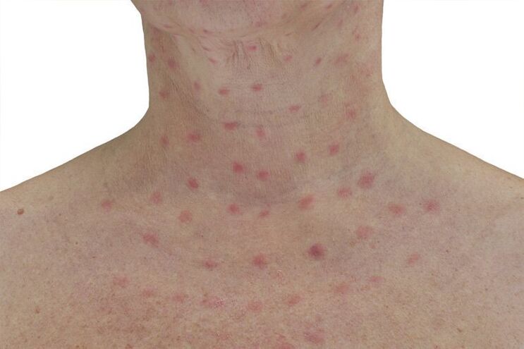 Skin after electrocoagulation