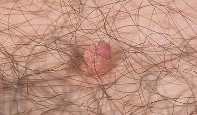Ways to transfer the human papilloma virus