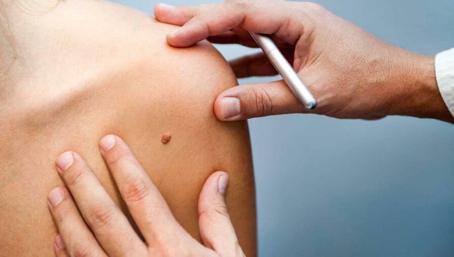 A dermatologist examines a patient with papilloma