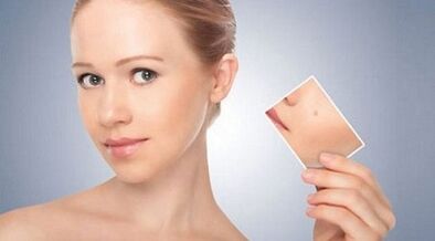 Review of effective treatments for warts and papillomas