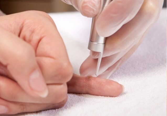 removal of warts on the finger