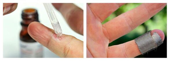 Chemical methods for treatment of warts