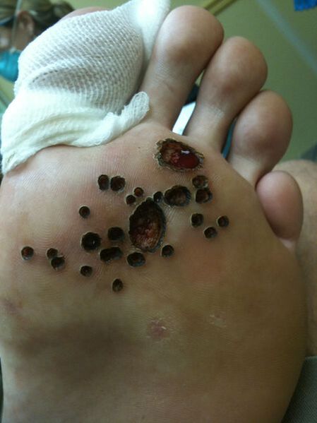 Leather after laser removal of the warts on the feet