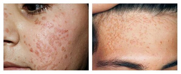 Straight warts on the face