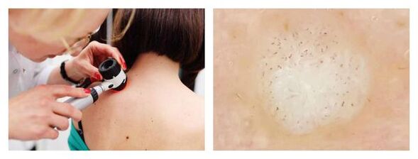 The dermatoscopy of the wee