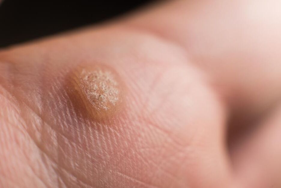 human papillomavirus in the skin