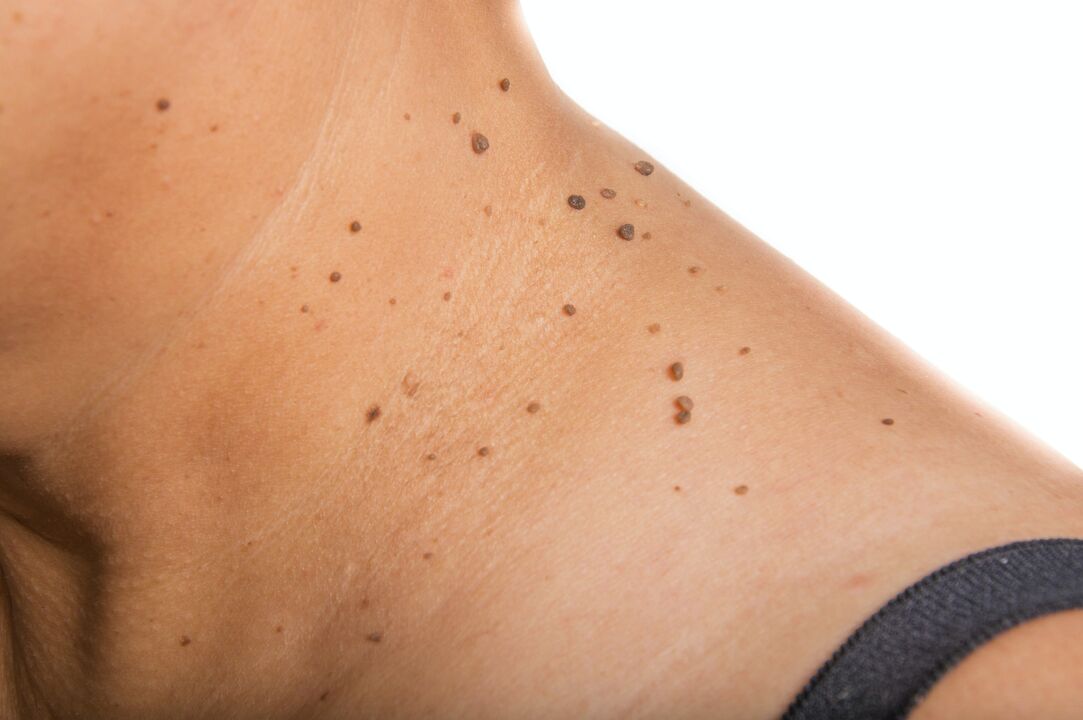 Scattering of papillomas on the neck