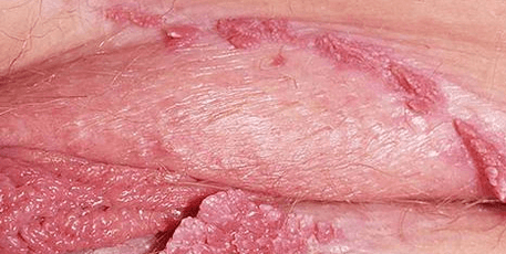 Canciloma