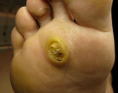 Subany Papillomas